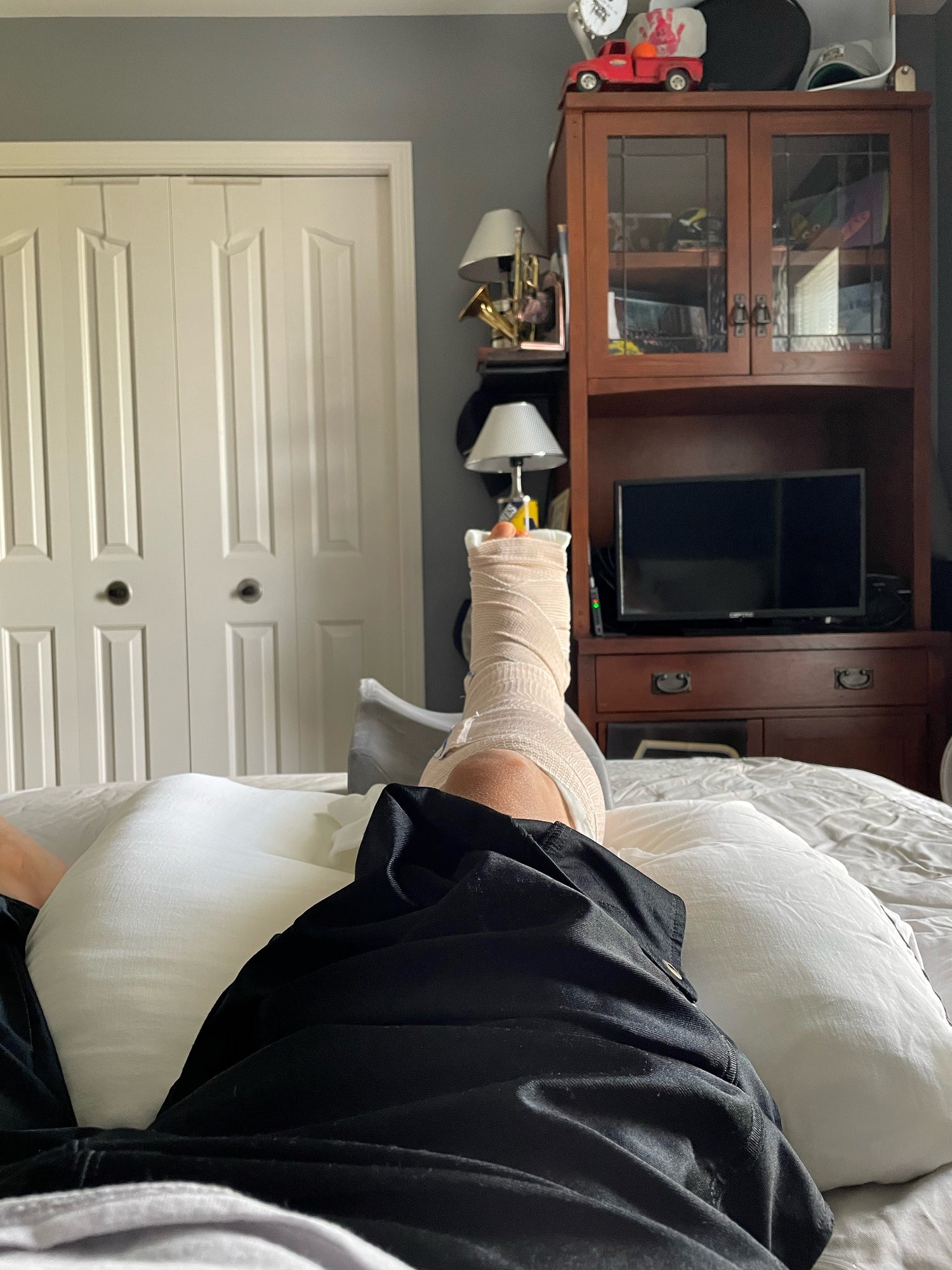 Stepping into Recovery: My Ankle Surgery Journey