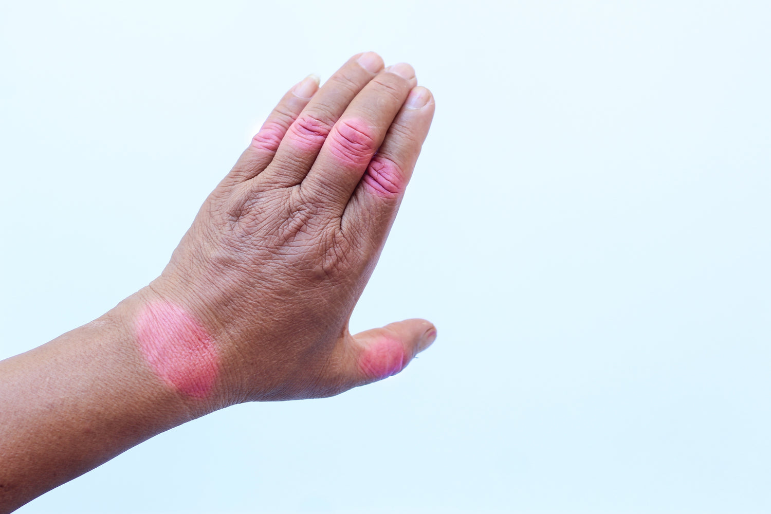 Relieving the Aches: What's the Best Solution for Rheumatoid Arthritis Pain?