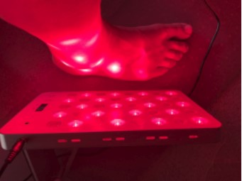 Illuminating Recovery: Red Light Therapy's Role in My Journey to Ankle Reconstruction